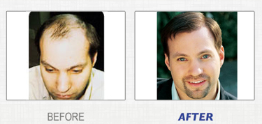 the better hair growth of user results. It shows before using and after using the laser comb.