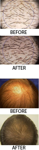 hair growth improvement
